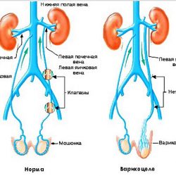 ВАРИКОЦЕЛЕ МОЖЕТ ЛИШИТЬ ВАС ПОТОМСТВА