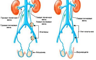 ВАРИКОЦЕЛЕ МОЖЕТ ЛИШИТЬ ВАС ПОТОМСТВА