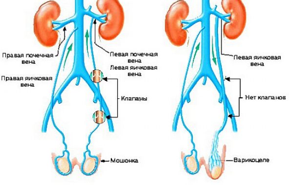 varikotsele-600x380 Варикоцеле может лишить вас потомства