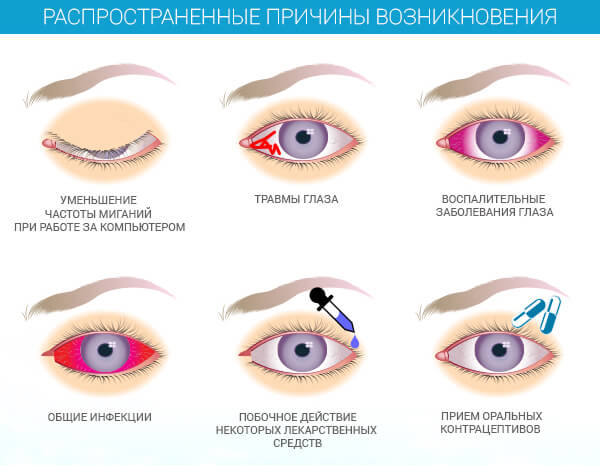 SINDROM-SUHOGO-GLAZA Синдром «сухого глаза», моргайте чаще